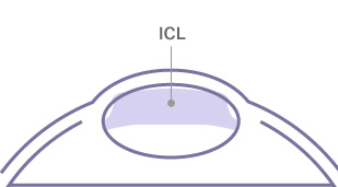 ICL挿入