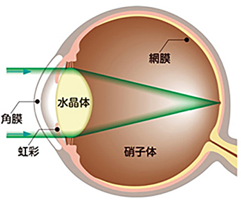 眼内レンズ