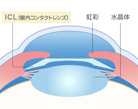 長岡 眼科 近視 近視矯正手術 眼内コンタクトレンズ Icl について 長岡眼科医院